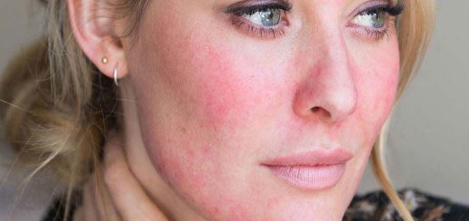 Cuidado de la piel seca e irritada