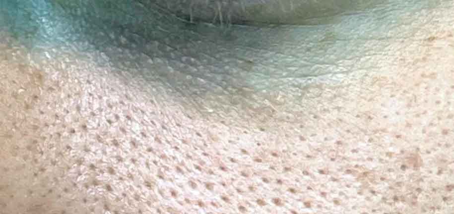 Poros Dilatados en el Rostro