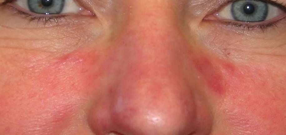 Rutina para Piel Seborreica