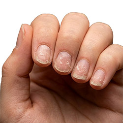 Uñas frágiles