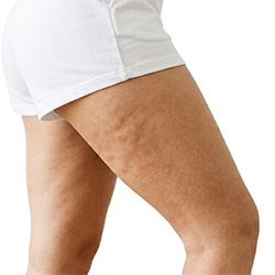 Productos para el cuidado de la piel con celulitis para el cuidado corporal