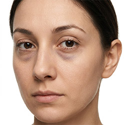Cuidado para Ojeras y Bolsas