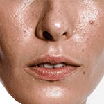 Cuidado de la piel grasa