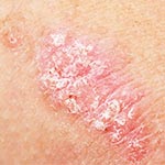 Cremas y tratamientos para la psoriasis para piel seca y descamada
