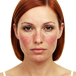Productos de cuidado facial para el enrojecimiento en piel sensible