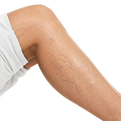 Productos de cuidado para los pies que ayudan a mejorar la apariencia de las venas visibles y la textura de la piel