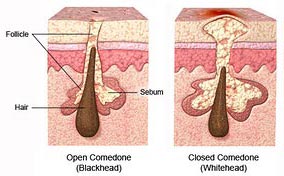 puntos negros y poros